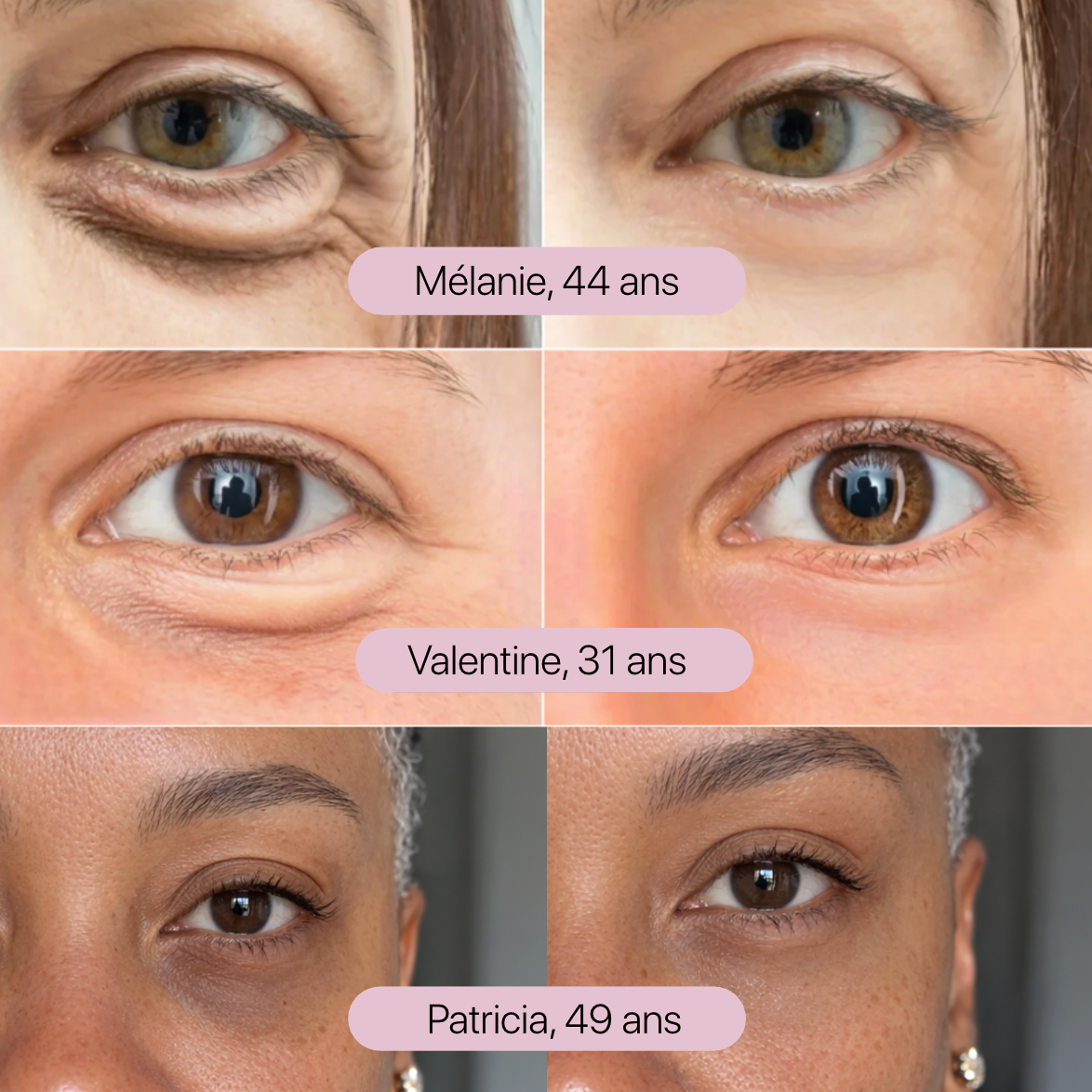 Patch 360® Paupière Tombante & Anti-Cernes